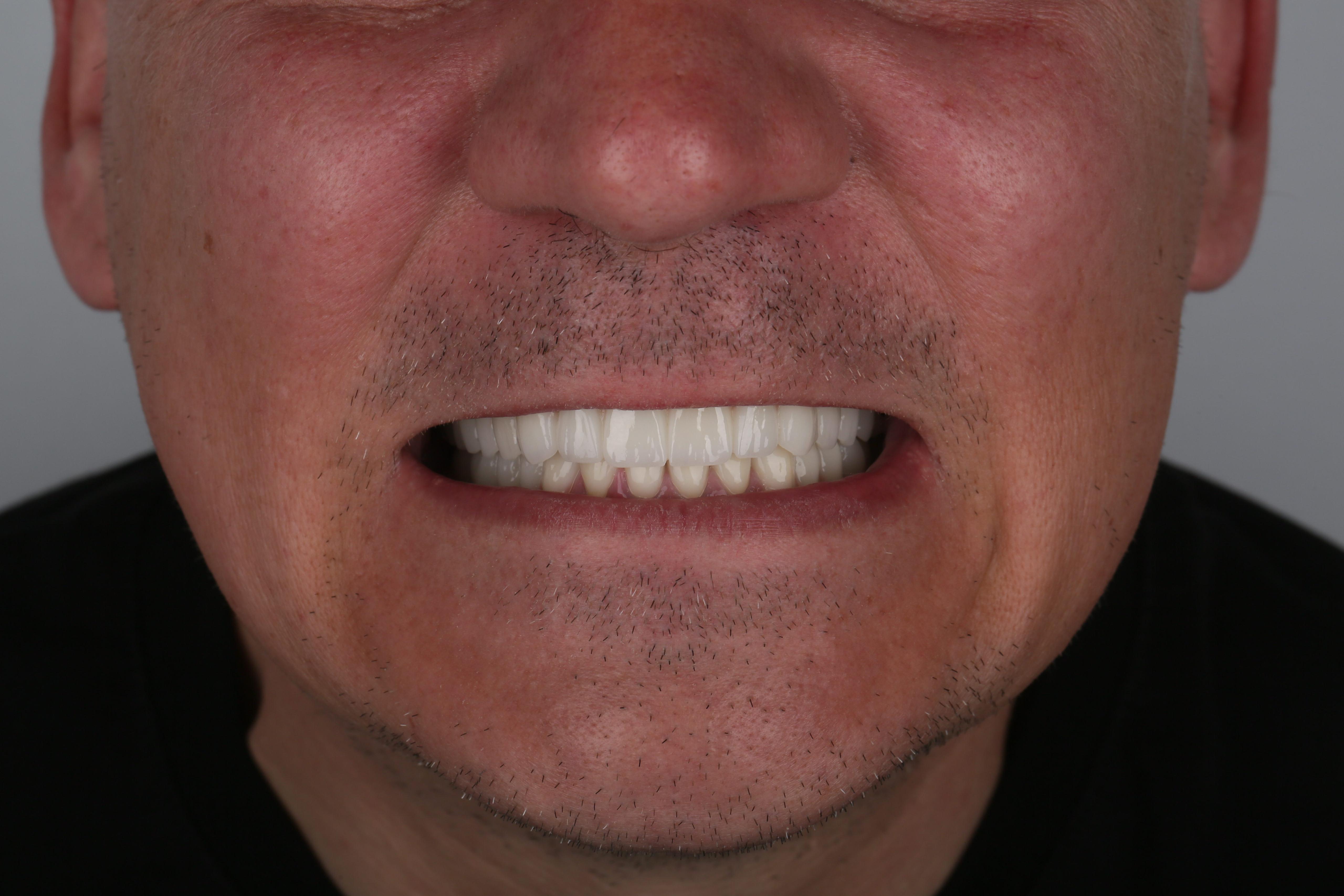 After treatment