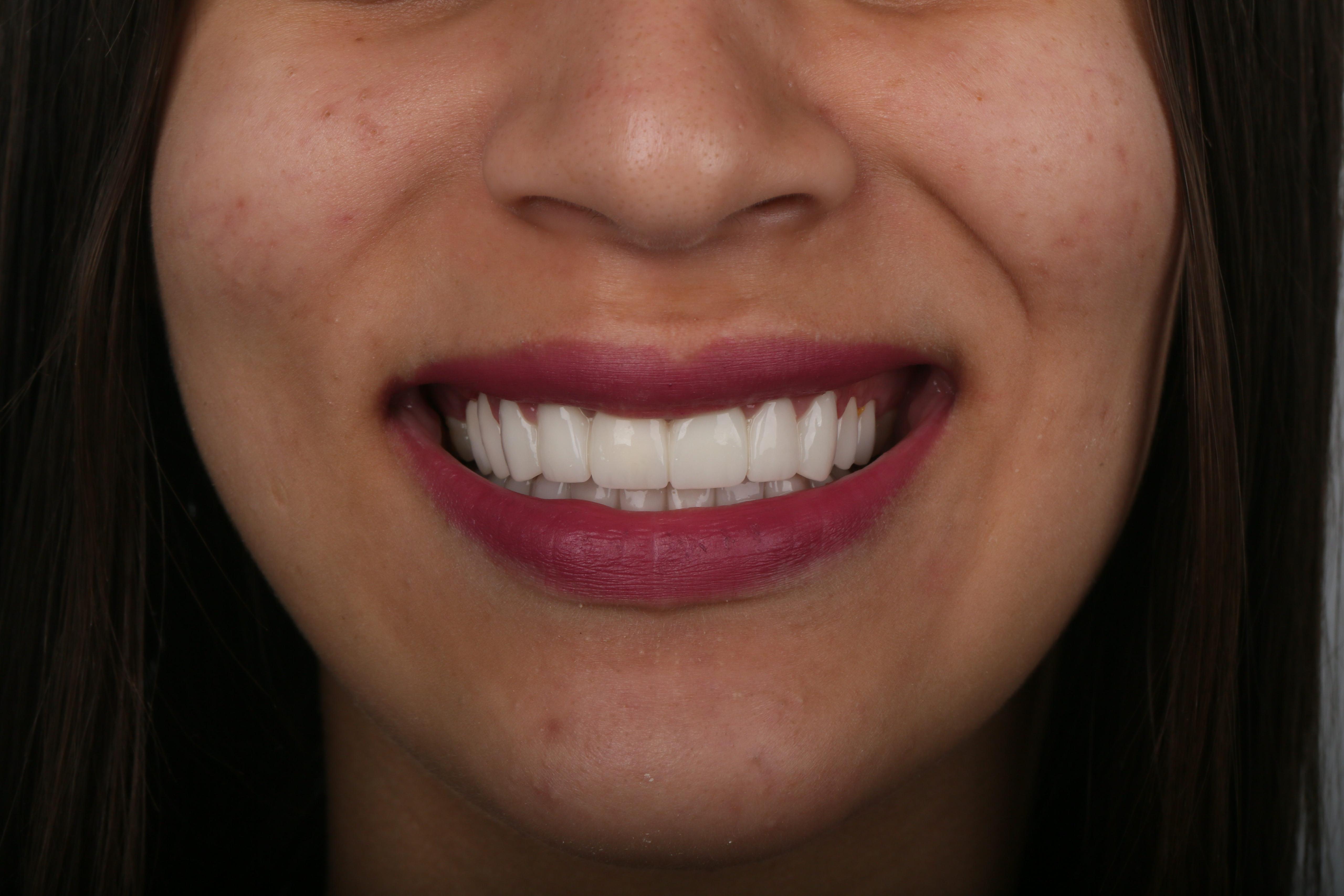 After treatment