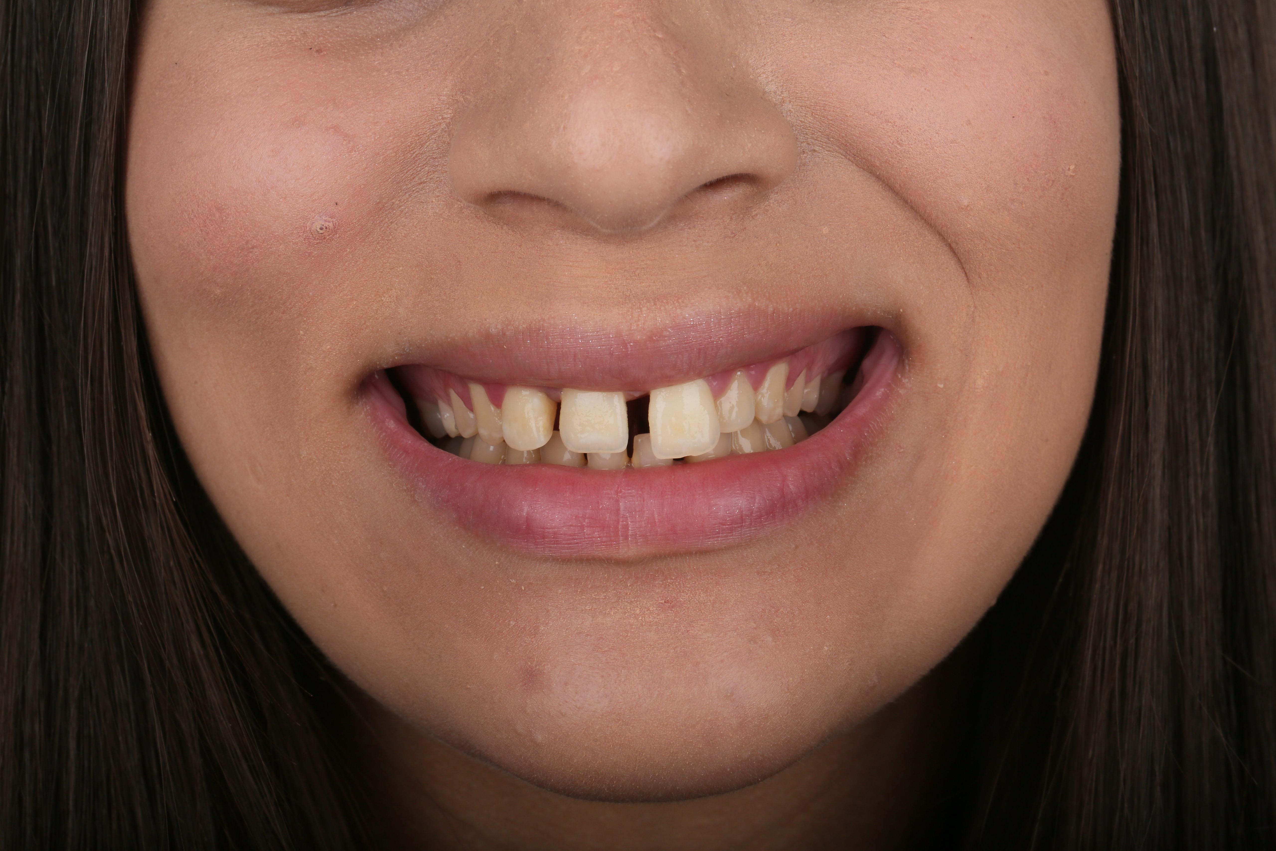 Before treatment
